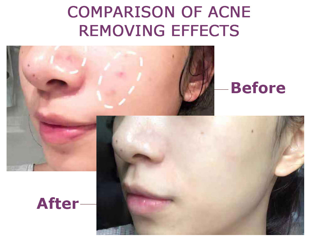 Yoxier Acne Patch – Invisible Spot Treatment Stickers (36 pcs) | Fast Acne Healing | لاصقات علاج حب الشباب غير مرئية