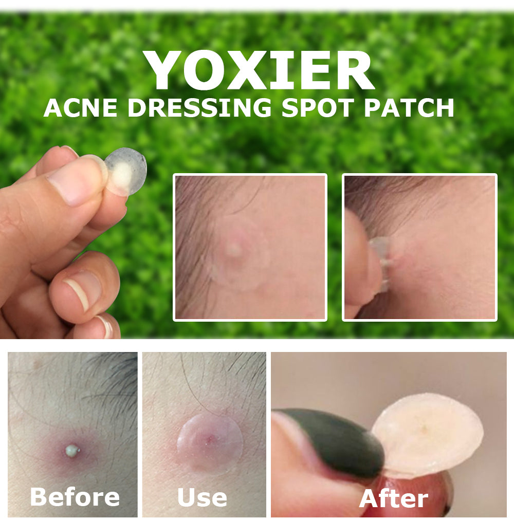 Yoxier Acne Patch – Invisible Spot Treatment Stickers (36 pcs) | Fast Acne Healing | لاصقات علاج حب الشباب غير مرئية