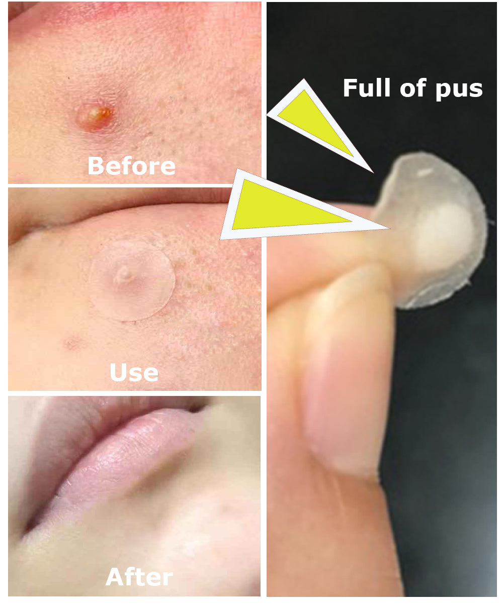 Yoxier Acne Patch – Invisible Spot Treatment Stickers (36 pcs) | Fast Acne Healing | لاصقات علاج حب الشباب غير مرئية